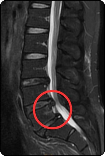 椎間板ヘルニア MRI画像 L4/L5