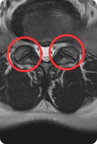 腰椎分離症 MRI画像